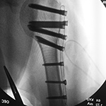 proximal humerus fixation