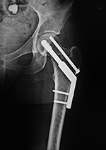 Dynamic Hip Screw