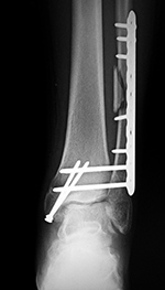 Bimalleolar fracture