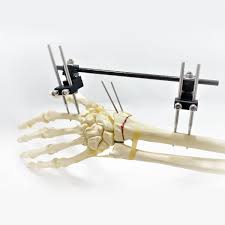 wrist external fixator