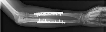 plate and screw fixation