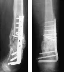 plate and screw fixation