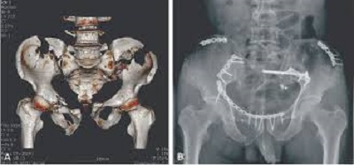 plate and screw fixation