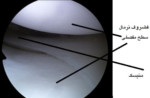 chondral layer