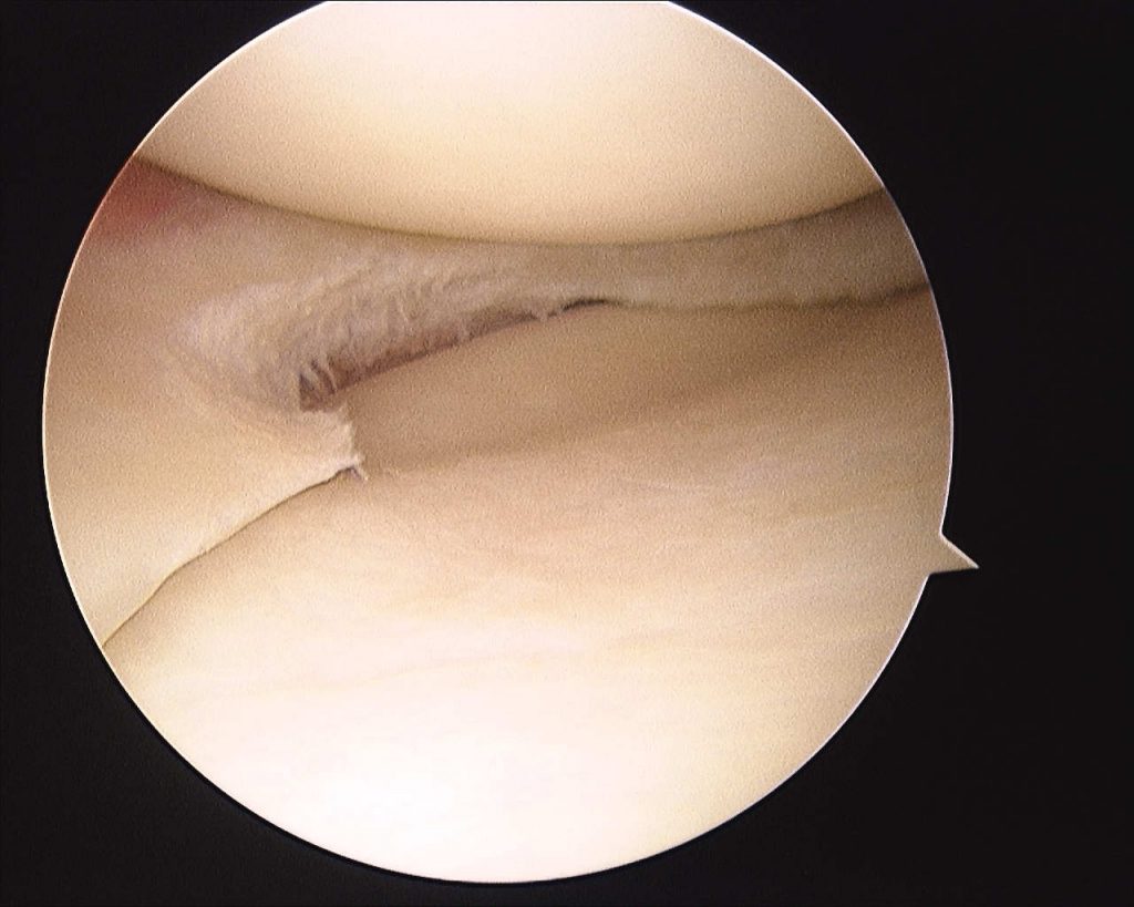 meniscal tear