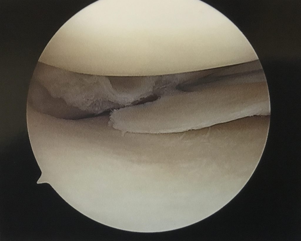 meniscal tear