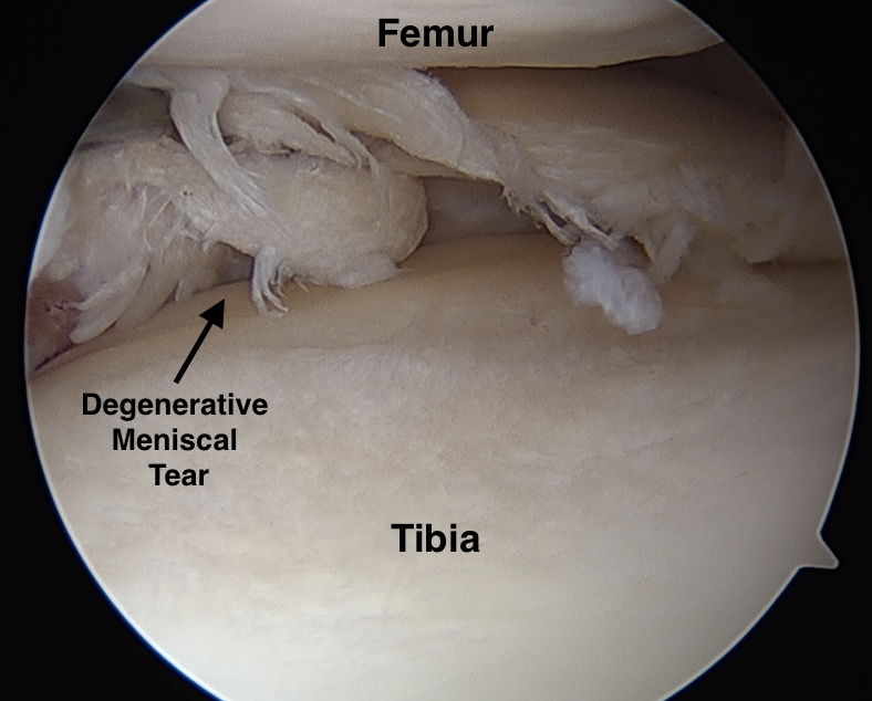 meniscal tear