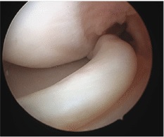 meniscal tear