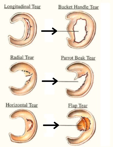 meniscal tear