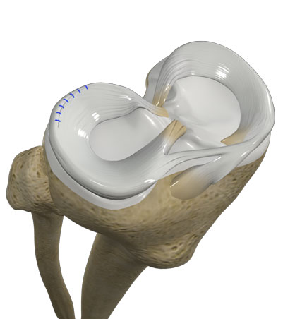 meniscal tear