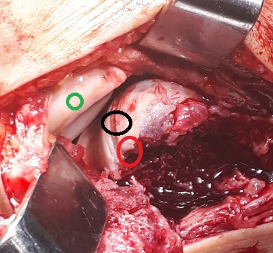 traumatic chondral injury