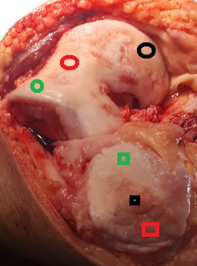 trauma and chondral injury