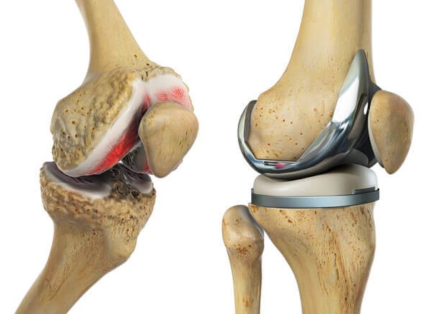 total knee replacement