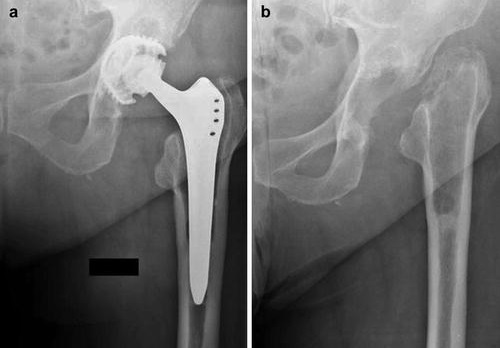 resection arthroplasty