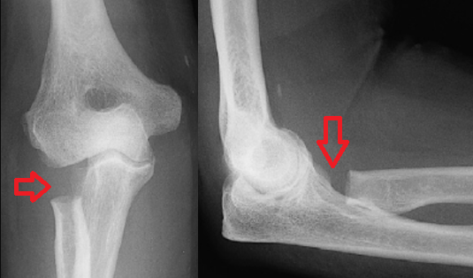 resection arthroplasty